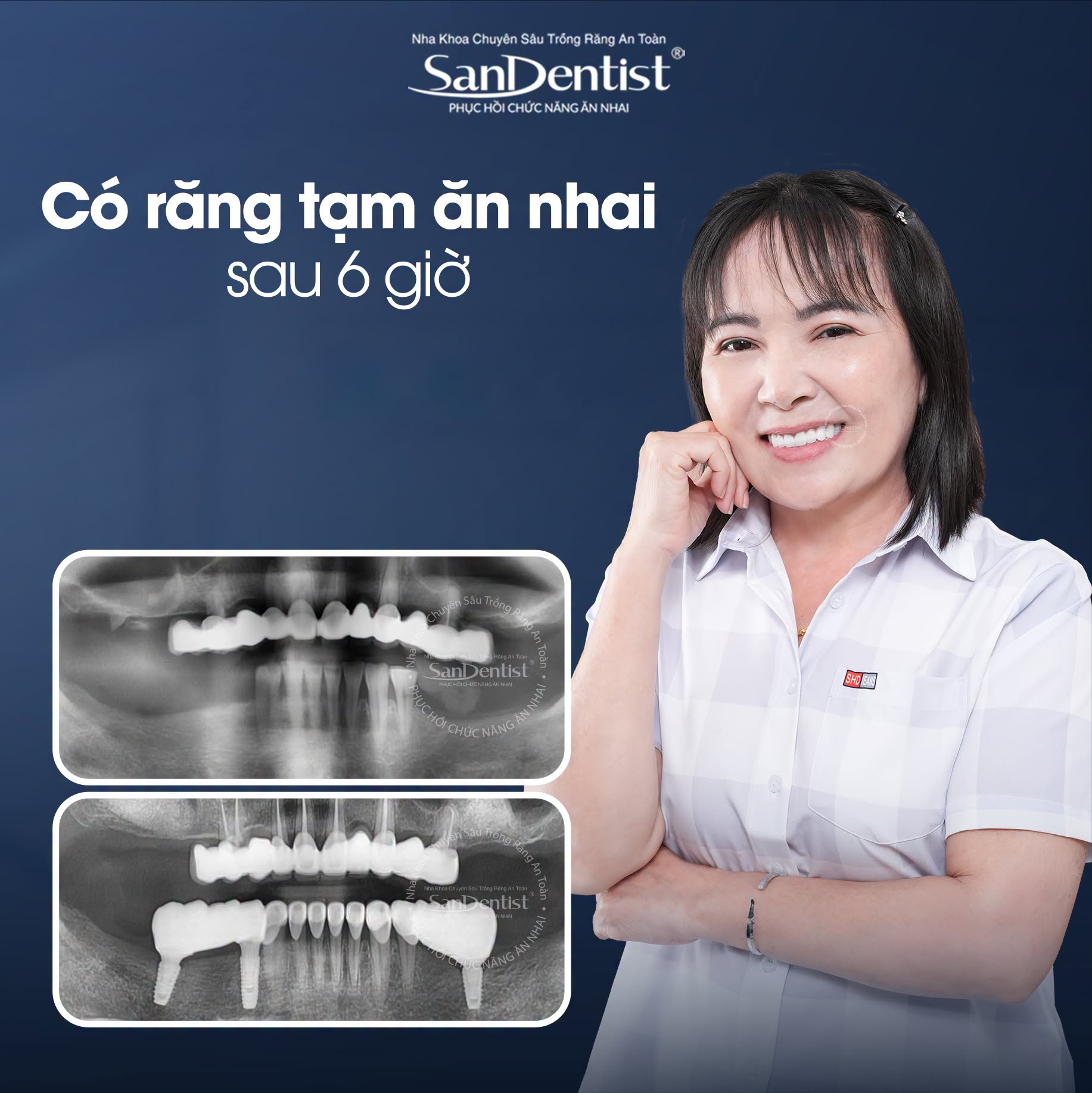 trồng implant 1 răng - hình 3
