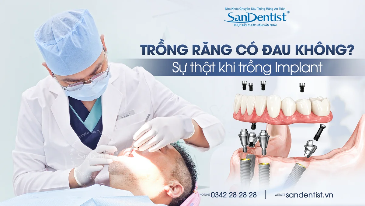 Trồng răng có đau không? Sự thật khi trồng Implant tại San Dentist