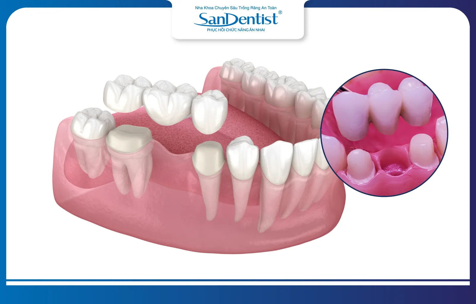 A dental bridge to restore a missing tooth