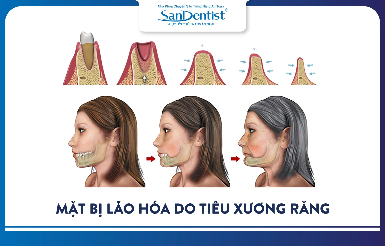 Jawbone atrophy causes facial aging