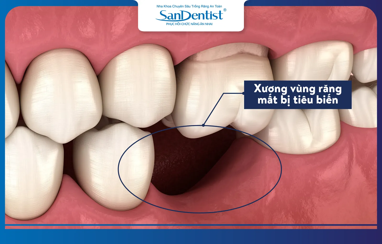 The jawbone in the area where teeth have been missing for a long time will resorb