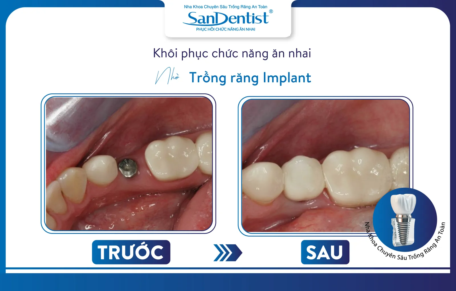Dental implants are an effective solution for restoring missing teeth