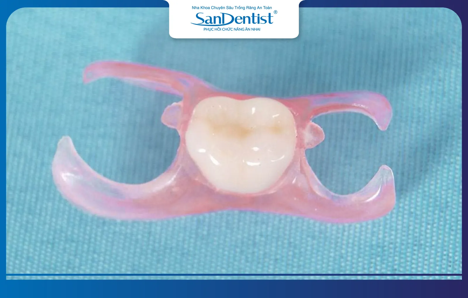 Removable single-tooth denture