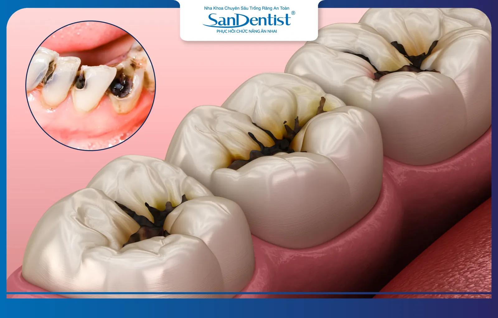 Untreated tooth decay can kill the pulp, leading to tooth loss