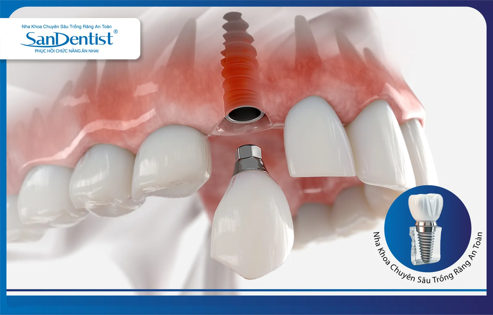 Dental implants replace a missing tooth