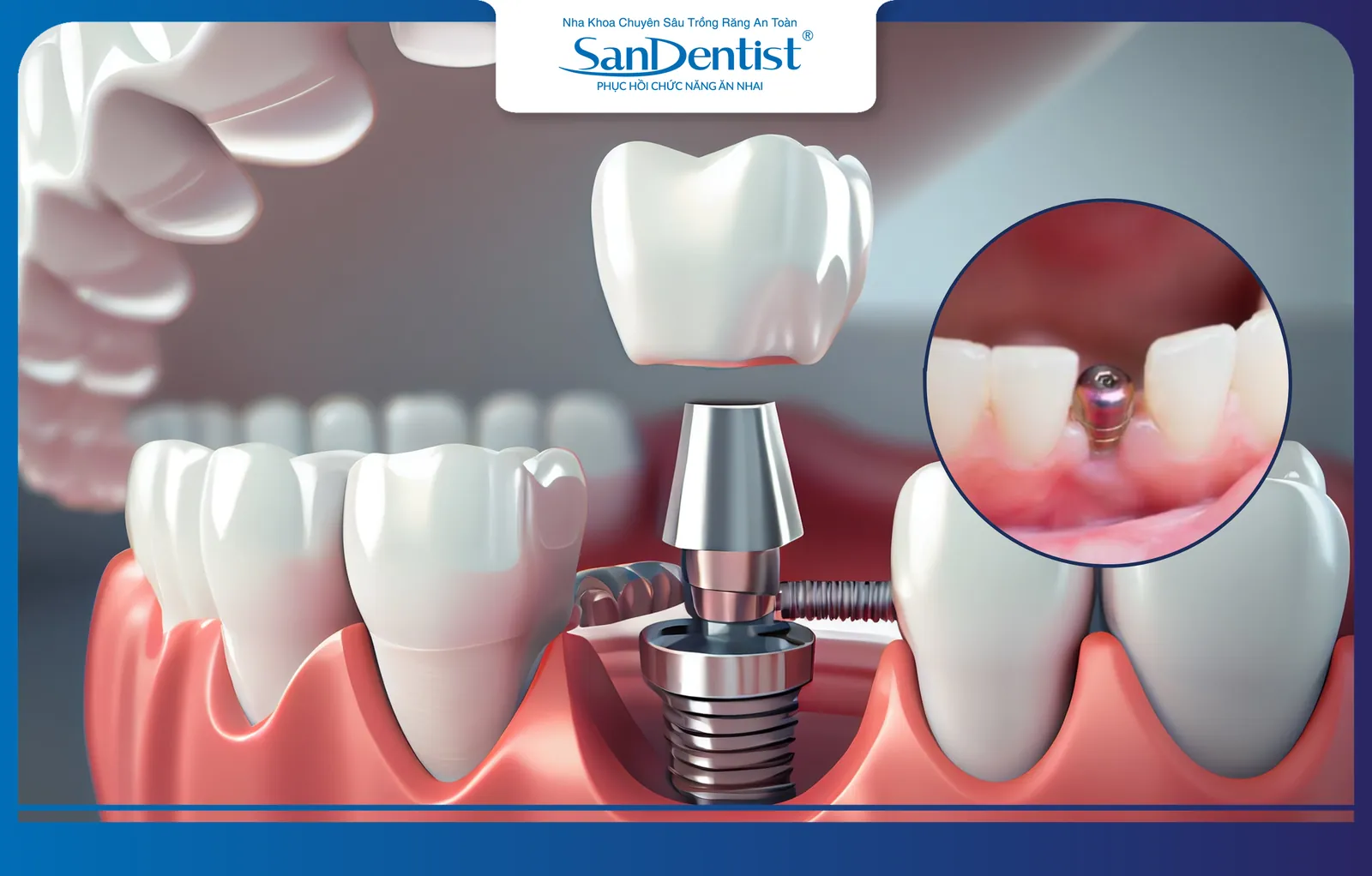 Dental implants provide the optimal solution for restoring missing teeth