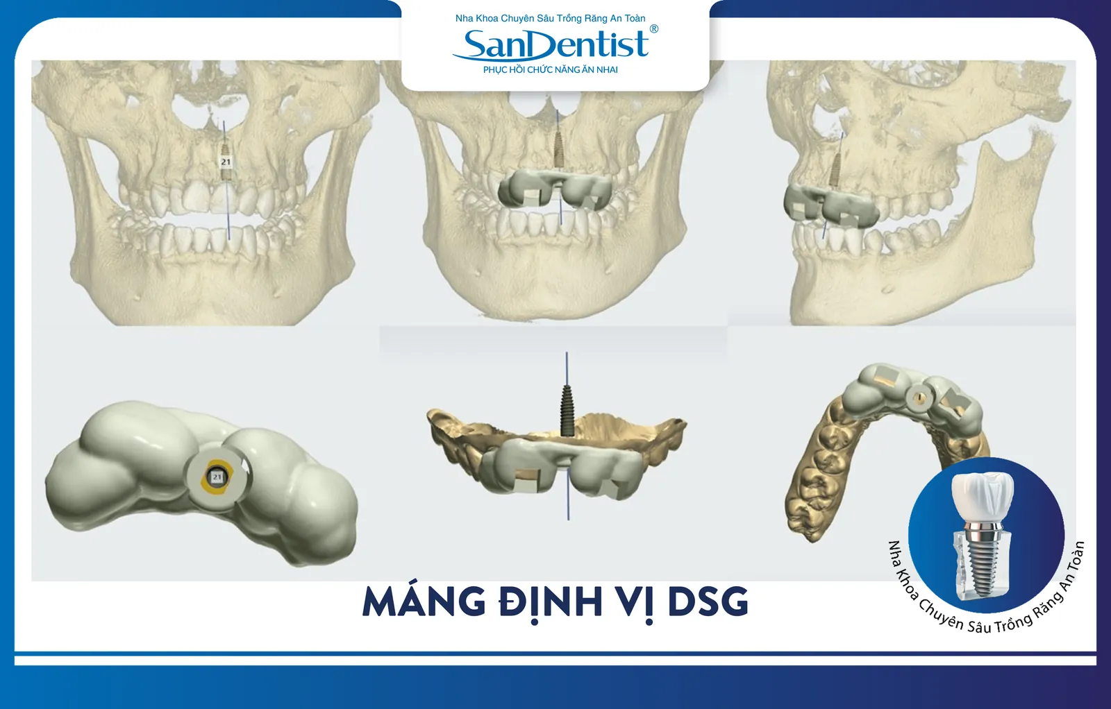 DSG surgical guide used in dental implant procedures