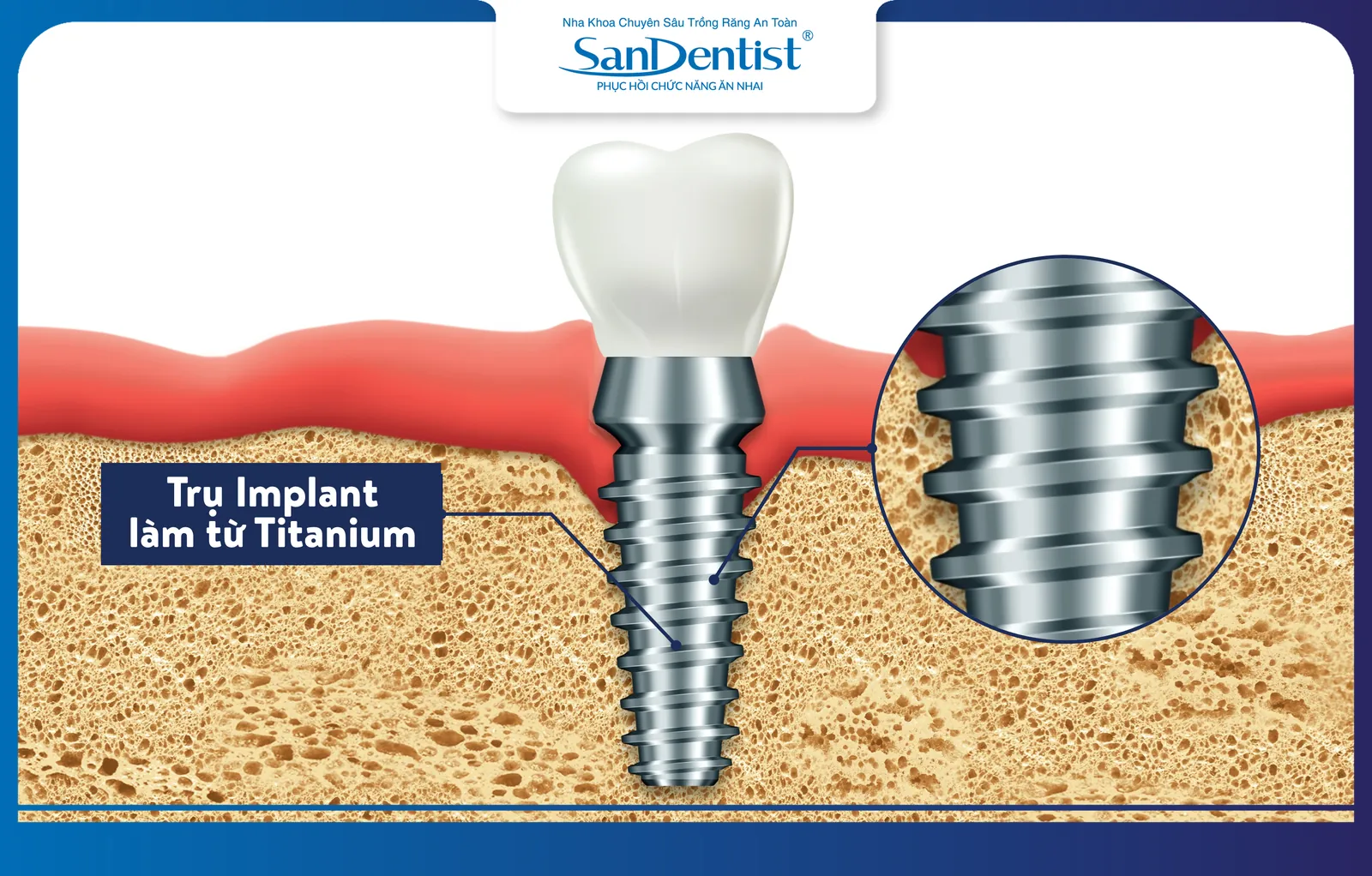 Titanium is a material used to make dental implants and is safe for the body