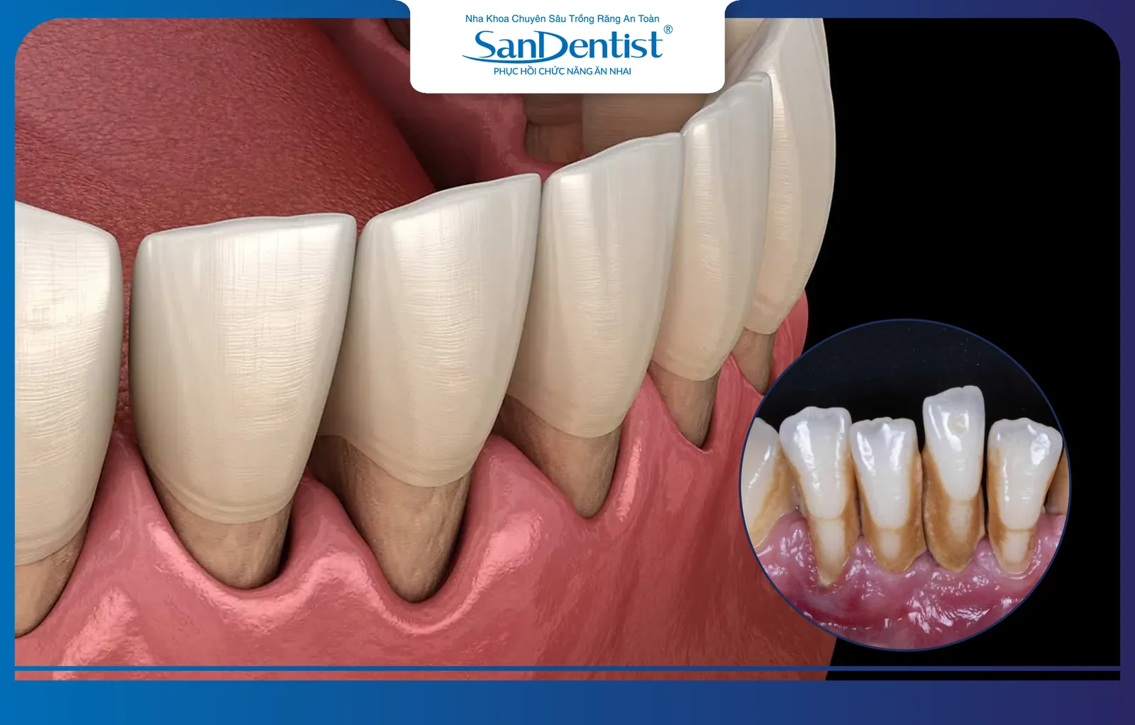 Periodontitis is one of the leading causes of tooth loss