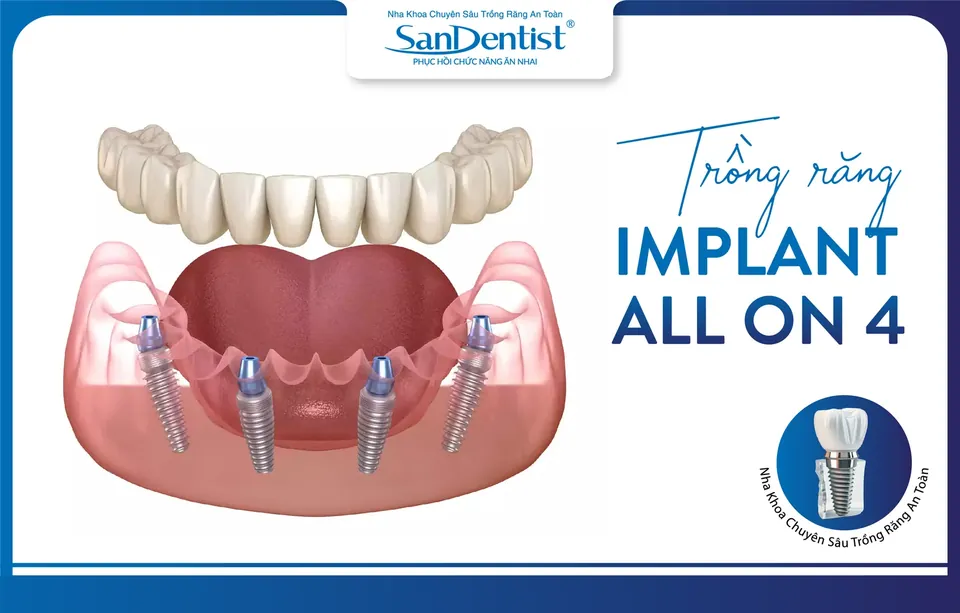 Trồng răng Implant toàn hàm All-on-4 với 4 trụ Implant nâng đỡ cả hàm răng