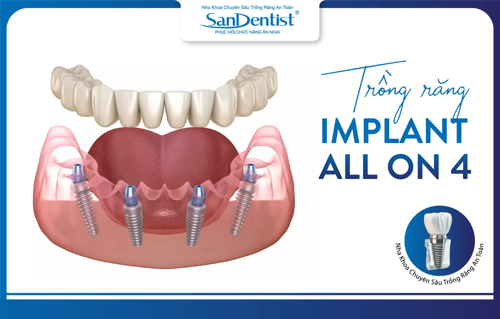 The All-On-4 full-arch implant method