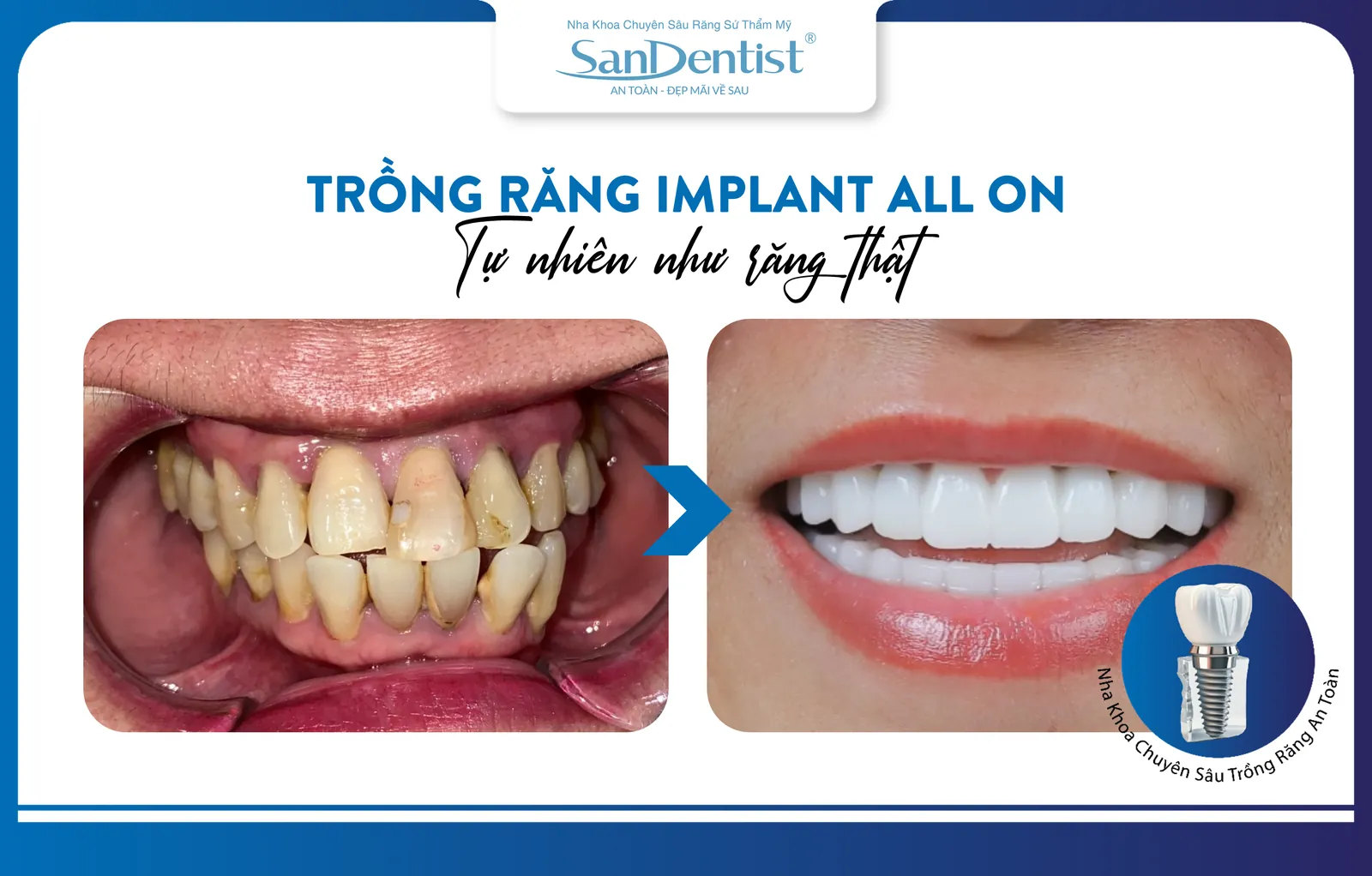 All-On Full Arch Implants: Natural Aesthetics Like Real Teeth