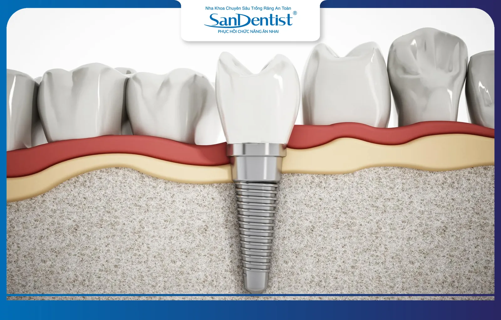 Dental implants after immediate placement and restoration