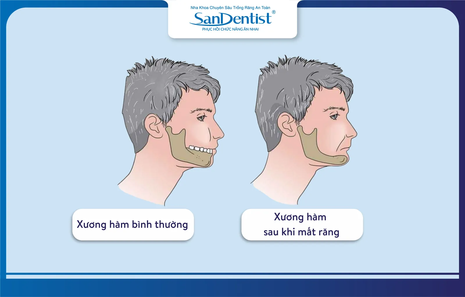Jawbone loss due to long-term tooth loss