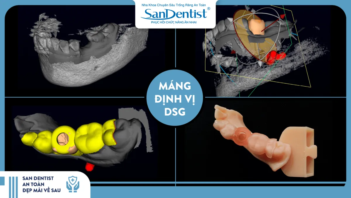 DSG surgical guide used in dental implant procedures