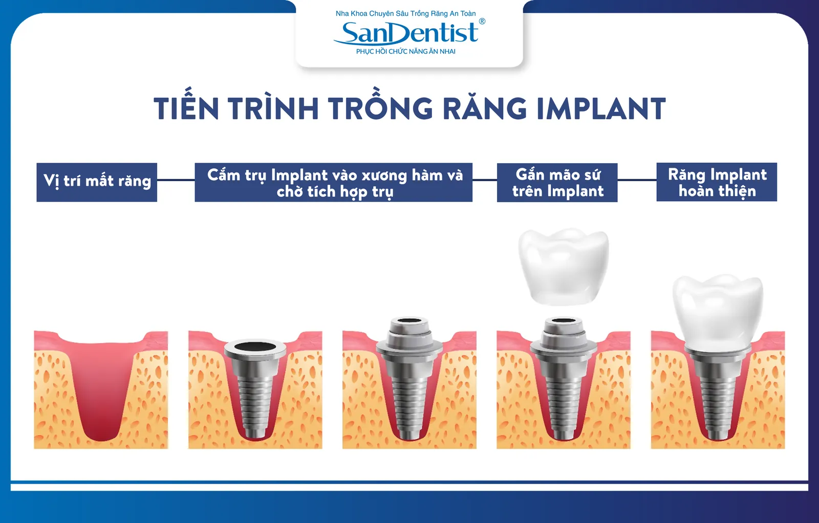 The process of dental implant surgery to restore missing teeth
